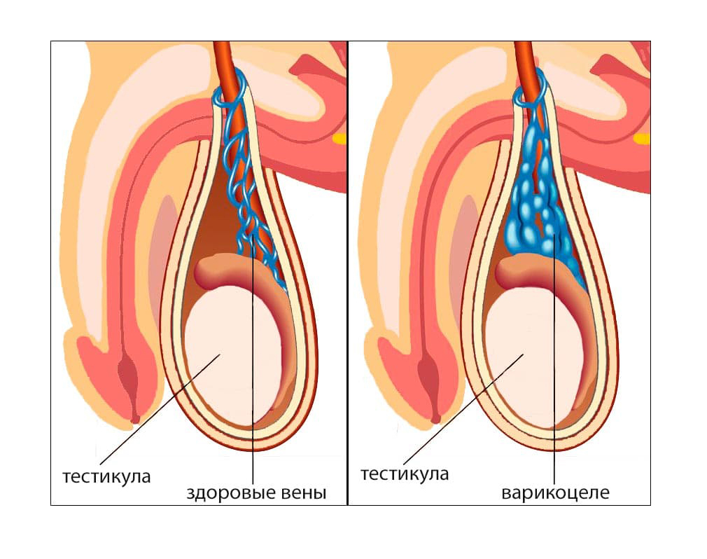 варикоцеле.jpg