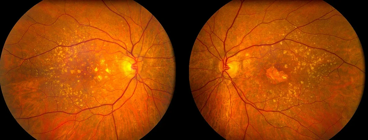 Периферическая хориоретинальная дистрофия сетчатки (ПХРД, ПВХРД)