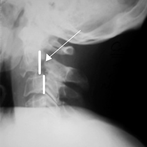 Рис.1 Перелом палача. Тело С2 смещено кпереди относительно С3 (спондилолистез). Стрелкой указан перелом ножки 