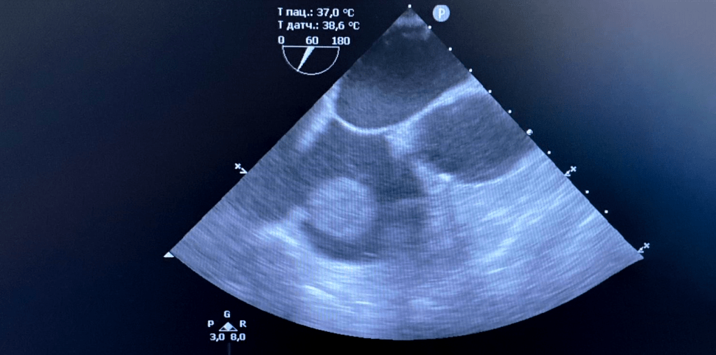 Эхокардиографическое изображение редкого случая миксомы нетипичной локализации – опухоль на ножке располагалась на границе правого предсердия и устья нижней полой вены. Больной успешно прооперирован в КВМТ им. Н.И. Пирогова СПбГУ в условиях искусственного кровообращения, кардиоплегии и гипотермической остановки кровообращения.