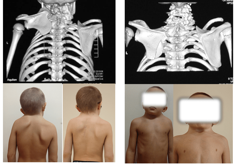 Левосторонний синдром Шпренгеля с фиксаций развернутой и недоразвитой лопатки к шейному отделу позвоночника. Костная кривошея на фоне множественных пороков развития (с-м Клиппеля-Фейля). КТ и фото до и после хирургической коррекции лопатки и шейного отдела позвоночника из одного доступа.
