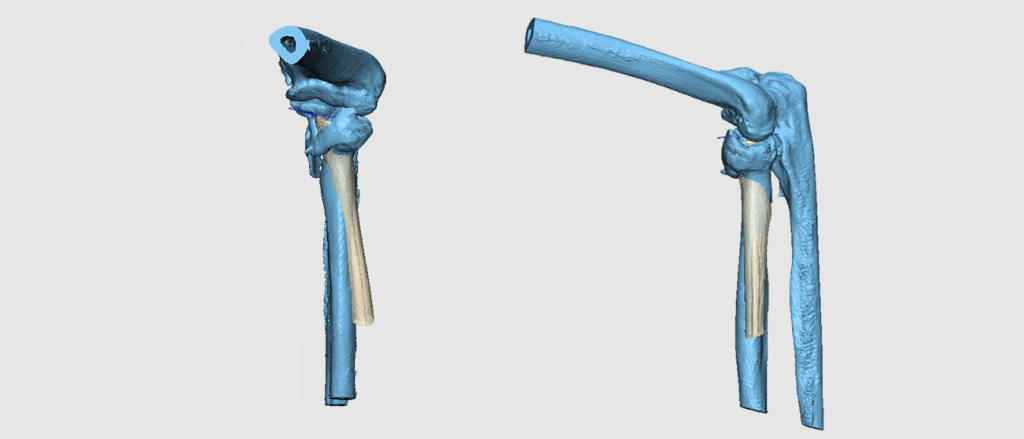 Рис. 5. Алгоритм работы: а. Взаимное расположение костей в суставе здоровой конечности принимается за верное положение. Производится 3Д симметрия здоровой конечности. Она накладывается на больную и определяется отклонение поврежденной от нормального состояния.