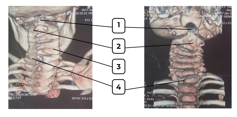 На изображении видны множественные пороки развития шейного отдела позвоночника у ребенка 3 лет: 1 - Spina bifida C1 (нарушение слияния), 2 - сращение С2-С3 (нарушение сегментации), 3 - задний полупозвонок С6 (нарушение формирования), 4 - полупозвонок Th1 (нарушение формирования).