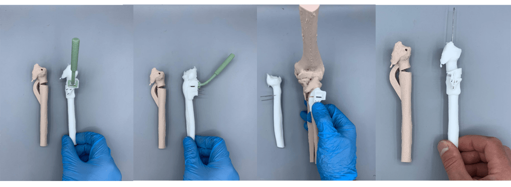 Рис.6. Далее разрабатывается индивидуальный хирургический направитель для корригирующей остеотомии таким образом, чтобы вернуть положение головки на свою позицию, ориентируясь на здоровую конечность.