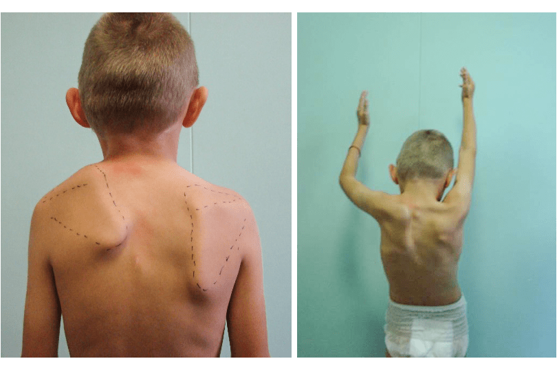 Внешний вид ребенка с синдромом Шпренгеля слева. Лопатка ротирована, смещена вверх, приближена к шее. Резко ограничен подъем вверх левой руки.