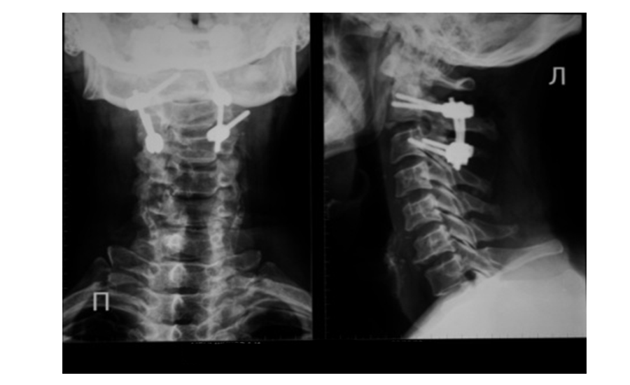  Рис.2 Произведена репозиция и фиксация перелома палача. Смещение устранено. Ножки позвонка соединены транспедикулярными винтами