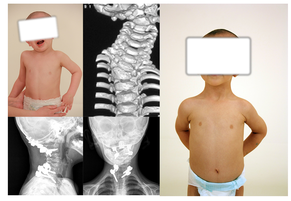 Мальчик, 3 лет с костной кривошеей на фоне множественных пороков развития шейного отдела позвоночника. Нестабильность в верхнешейном отделе позвоночника. Хирургическая коррекция. Устранение нестабильности и кривошеи