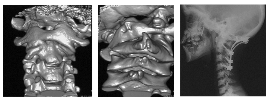 Рис.2 3Д КТ-реконструкция соотношений в С1-С2. Застарелый (1 год) левосторонний вывих в атланто-аксиальном сочленении. Костное сращение сустава в патологическом положении. Вторичные изменения в нижележащих позвонках для компенсации деформации. Произведена операция в большом объеме для исправления кривошеи. Восстановление правильного соотношения С1-С2 уже невозможно. Исправление деформации производится за счет нижележащих позвонков и вышележащего сочленения атланта и затылочной кости.