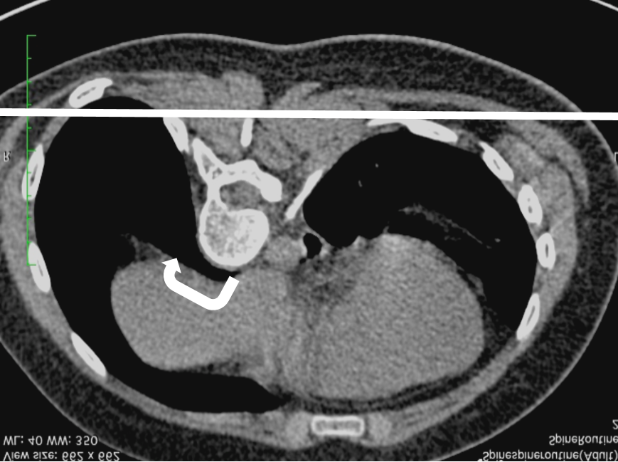 КТ позвоночника у пациента с идиопатическим правосторонним сколиозом.  Позвонки повернуты по часовой стрелке, скручивают грудную клетку и приподнимают ребра справа