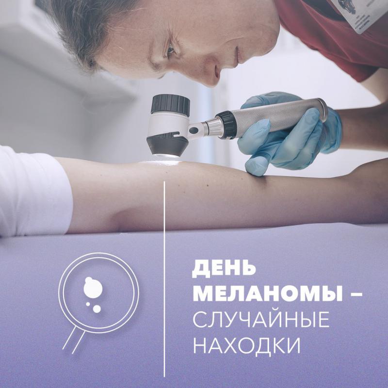 ДЕНЬ МЕЛАНОМЫ - случайные находки