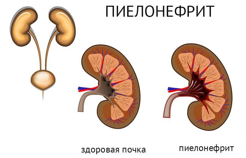 Реферат По Физкультуре Хронический Пиелонефрит