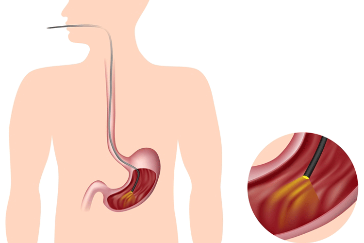 Выявление рака желудочно-кишечного тракта (ЖКТ) на ранних стадиях. Скрининг