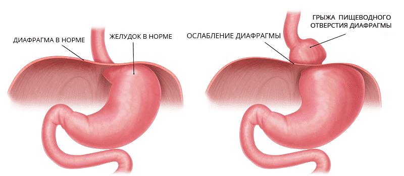 грыжа пищеводного отверстия диафрагмы.png