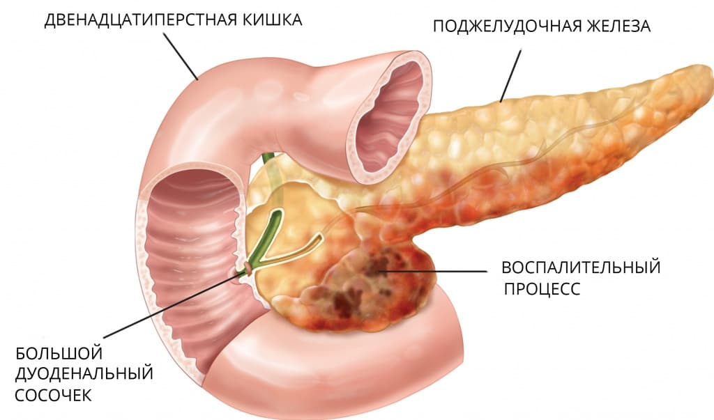 панкреатит.jpg