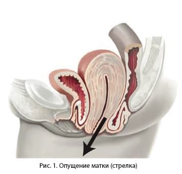 Как Выглядит Опущение Матки Фото