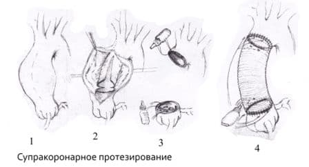 протезирование.jpg