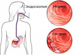 gastrit-diagnoz.jpg