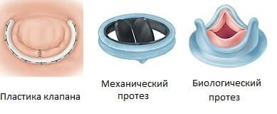 Лечение митральной недостаточности (4).jpg