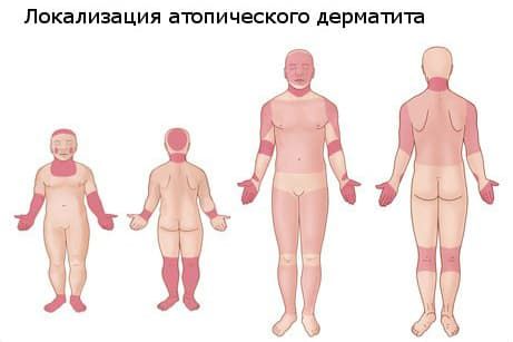 атопический дерматит.jpg