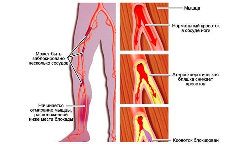 Облитерирующий атеросклероз артерий нижних конечностей 3.jpg