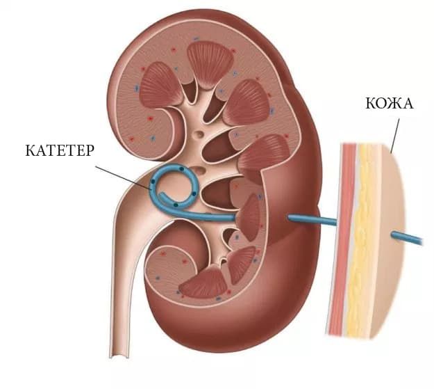 чрескожная нефростомия