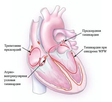 Пароксизмальные нар. ритма сердца 1.jpg