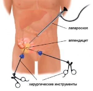 3.6_apendicut_operaciy.jpg
