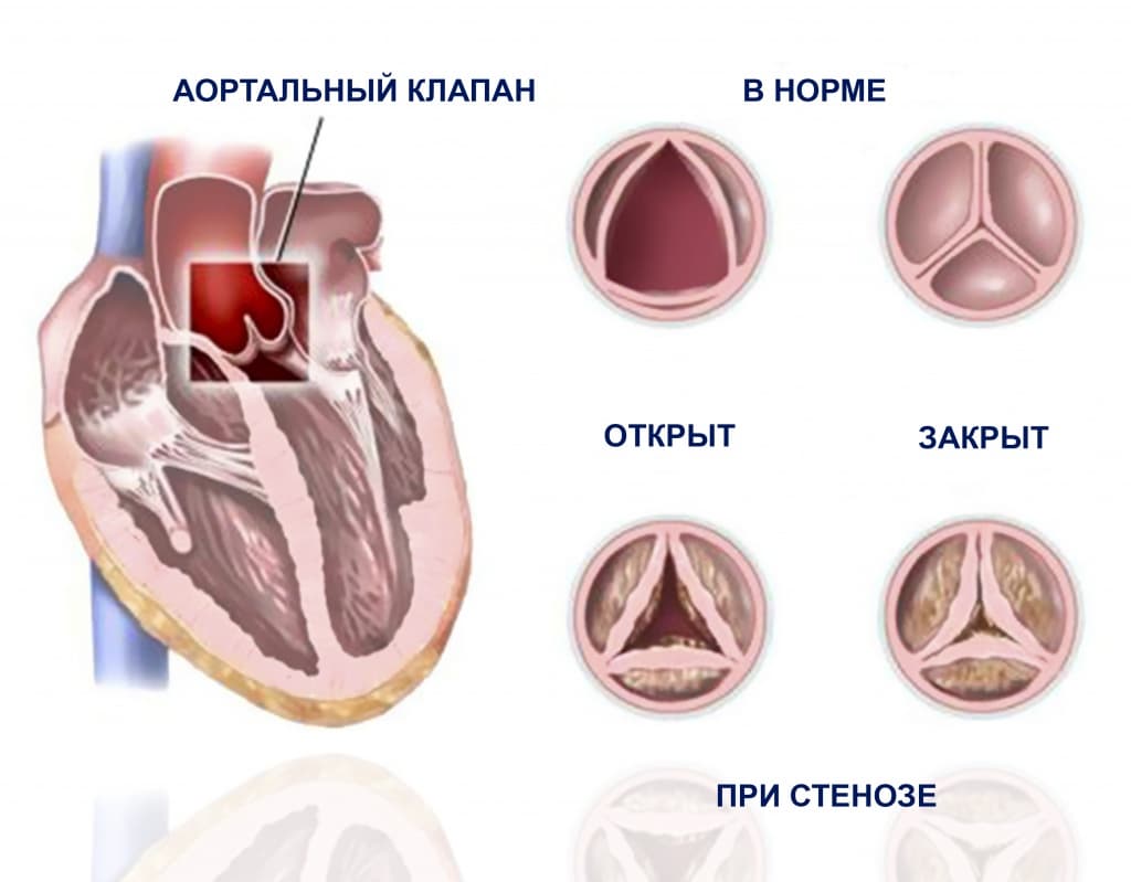 Реферат: Пороки сердца врожденные