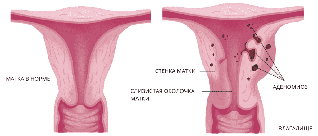 аденомиоз.png