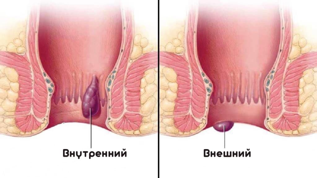 Геморрой Фото Людей