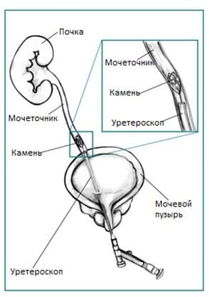 Виды Почечных Камней Фото