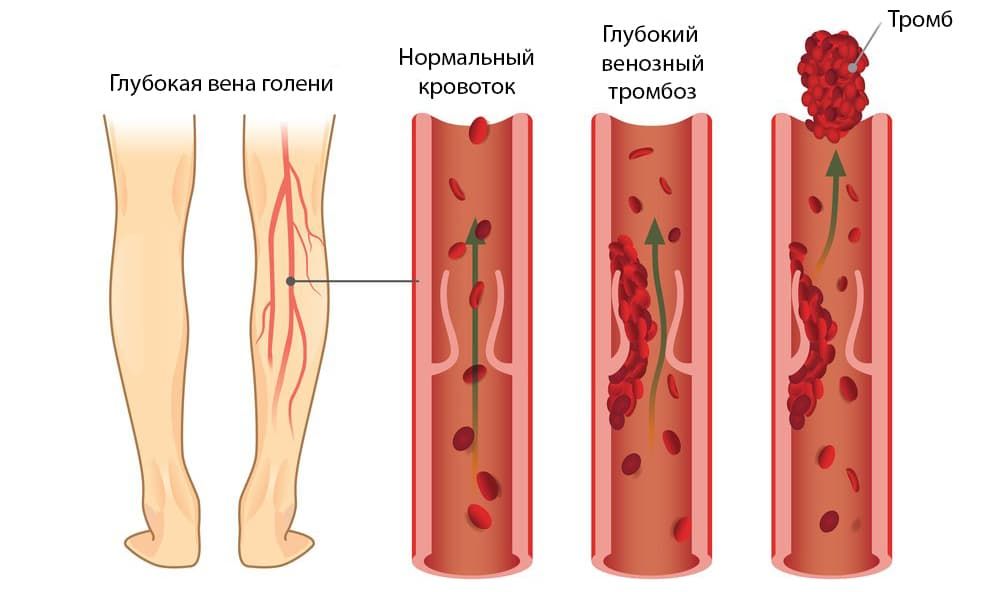тромбофлебит.jpg