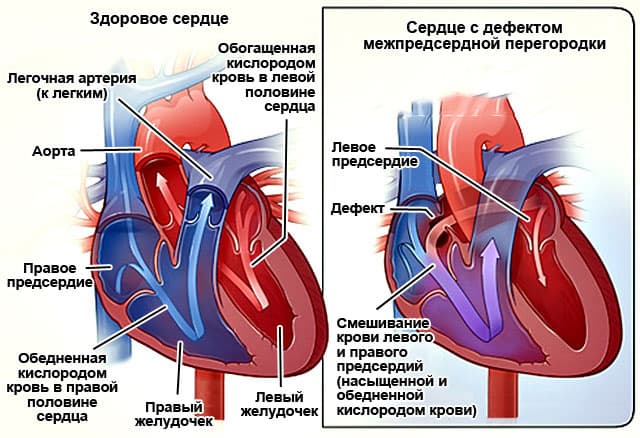 Где Находится Левое Предсердие У Человека Фото