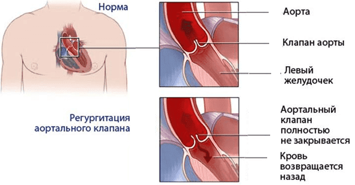 Реферат: Недостаточность клапанов и сужение отверстия легочной артерии