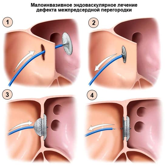 дефект перегородки (3).jpg