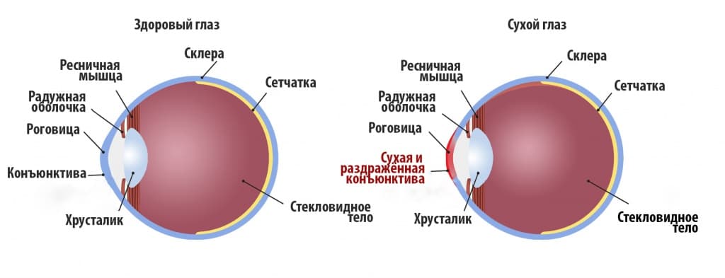 синдром сухого глаза2.jpg