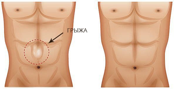 Грыжа белой линии живота: симптомы, операция по удалению, ущемление грыжи, грыжа белой линии живота