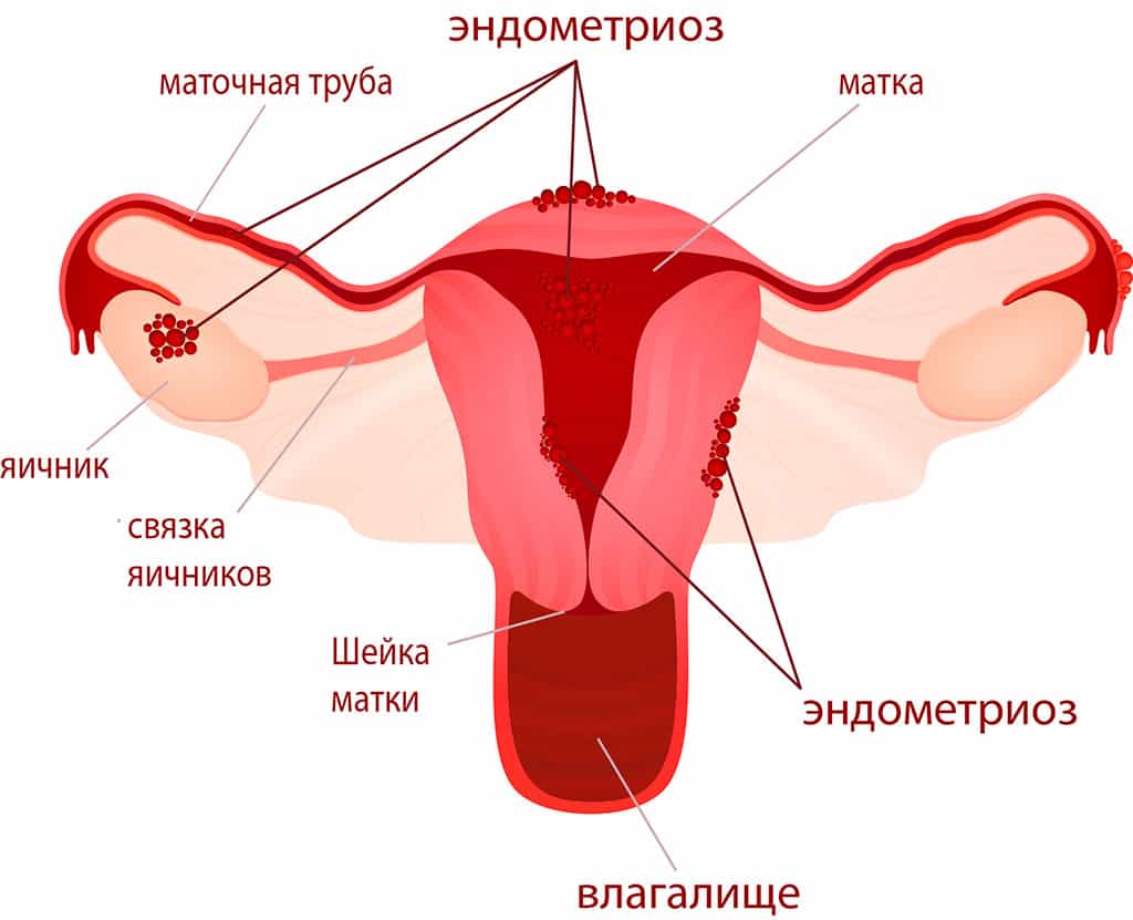 Как Выглядит Эндометриоз Фото