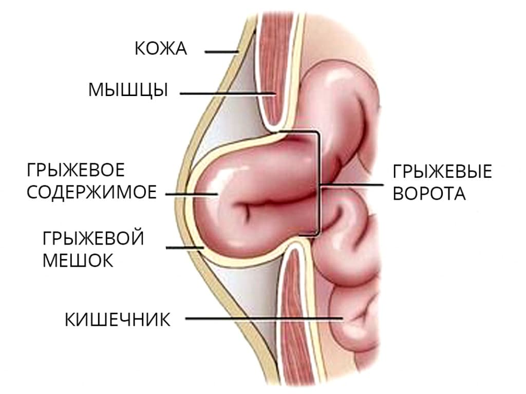 Грыжа Под Фото