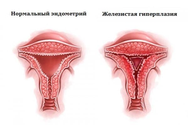 Гиперплазия и полипы эндометрия матки: лечение, выскабливание эндометриоза,  цена в СПб