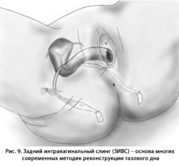 Влагалищные (пластические) операции