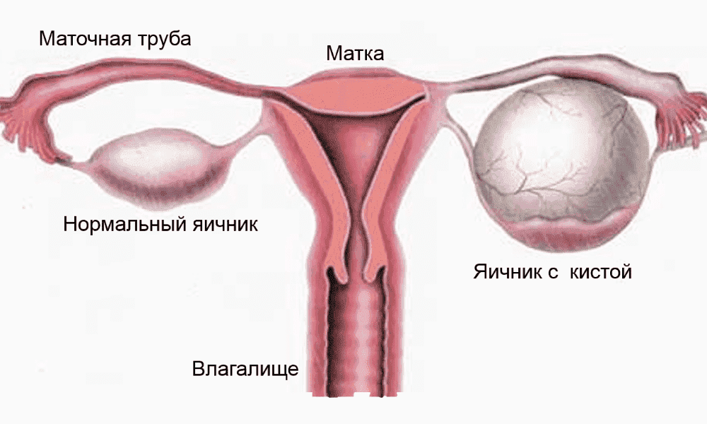 Симптомы перекрута кисты яичника беременность после лапароскопии форум