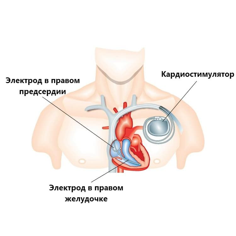 Нарушение ритма сердца (3).jpg Нарушение ритма сердца (3).jpg