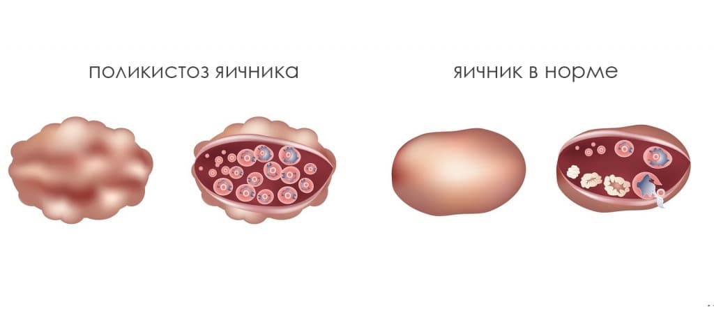 Как Выглядит Яичники Фото