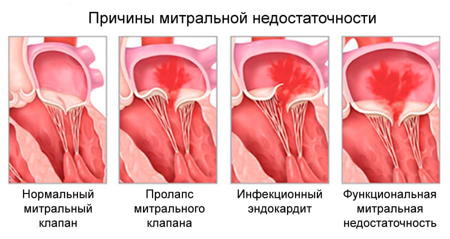 Реферат: Недостаточность клапанов и сужение отверстия легочной артерии