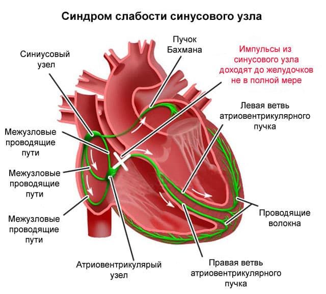 Реферат: Терапия (СИНДРОМ СЛАБОСТИ СИНУСОВОГО УЗЛА)