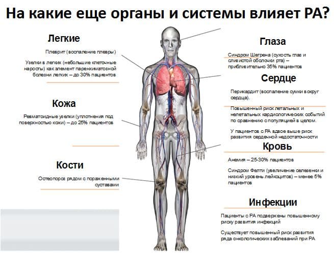 Диагностика ревматоидного артрита в санкт петербурге thumbnail