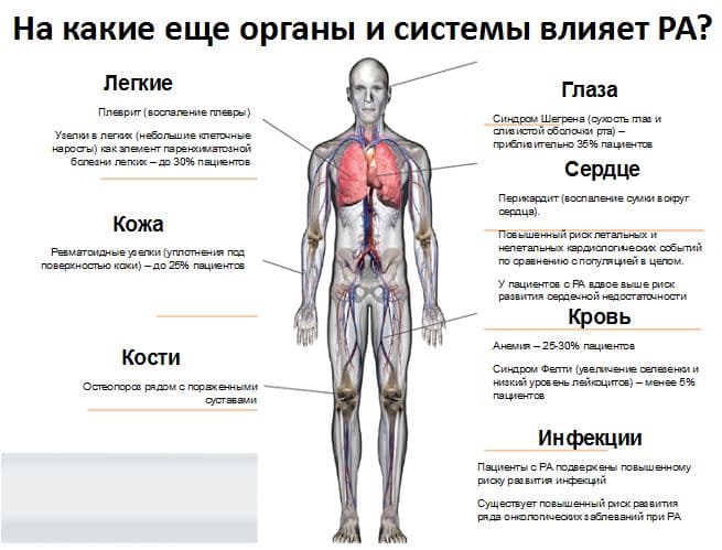 Реферат: Ревматоидный артрит