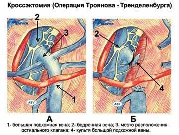 кросэктомия.jpg кросэктомия.jpg