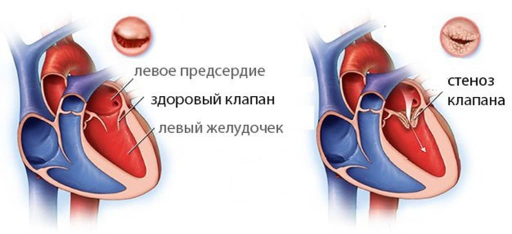 Доклад: Пороки сердца приобретенные